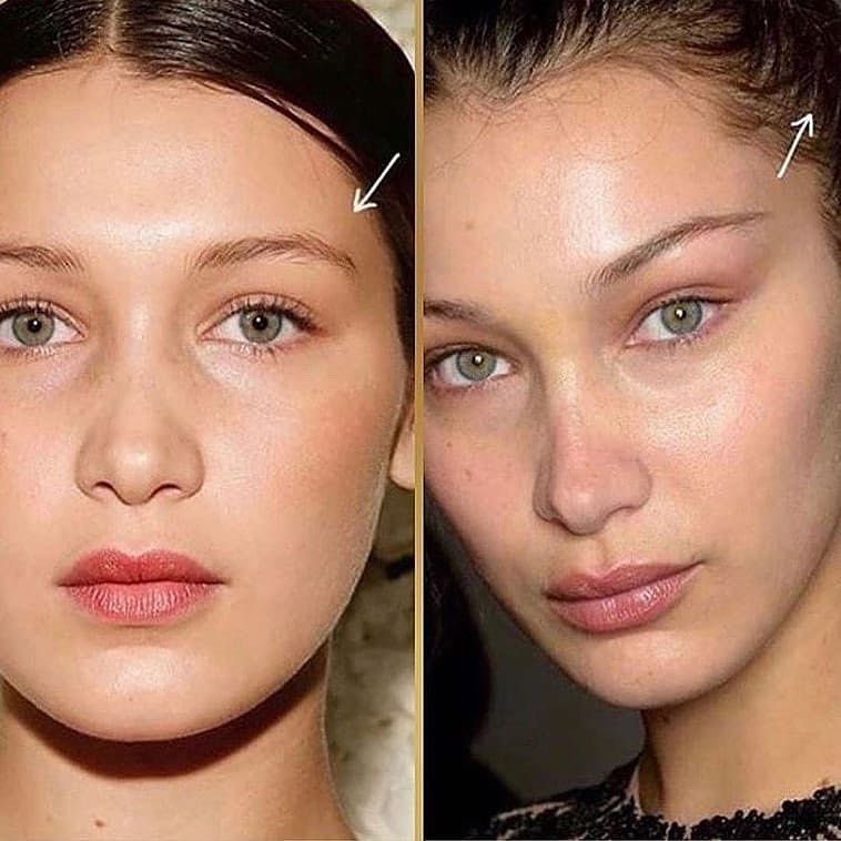Eyebrow Lift in Sri Ganganagar
