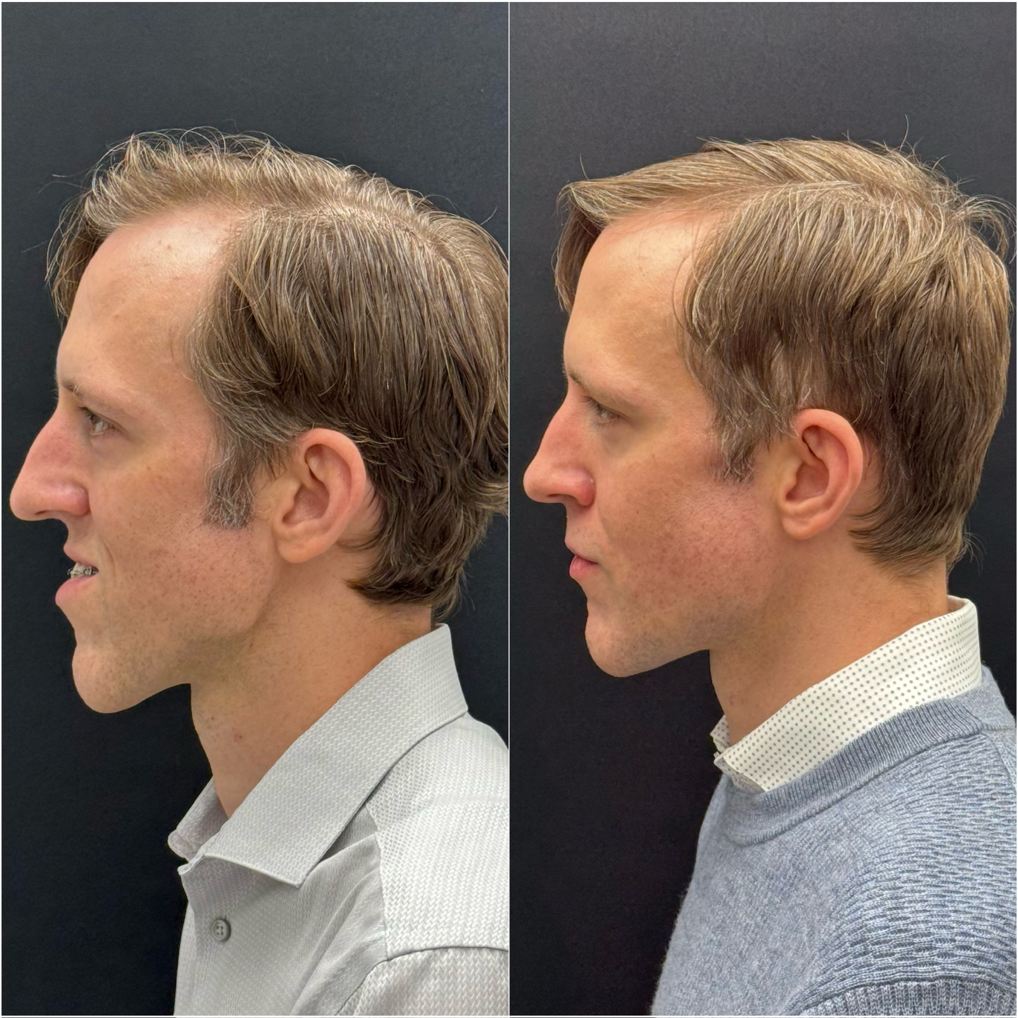 Facial Implant in Sri Ganganagar