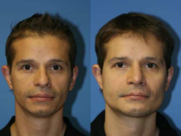 Facial Implant in Sri Ganganagar