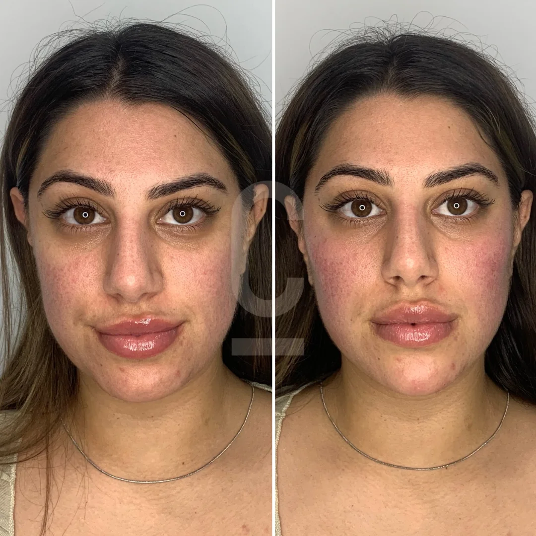 Face Slimming Treatment in Bikaner