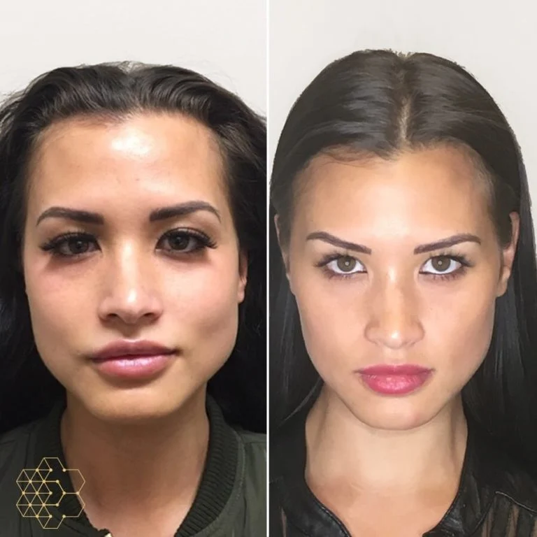 Face Slimming Treatment in Sri Ganganagar