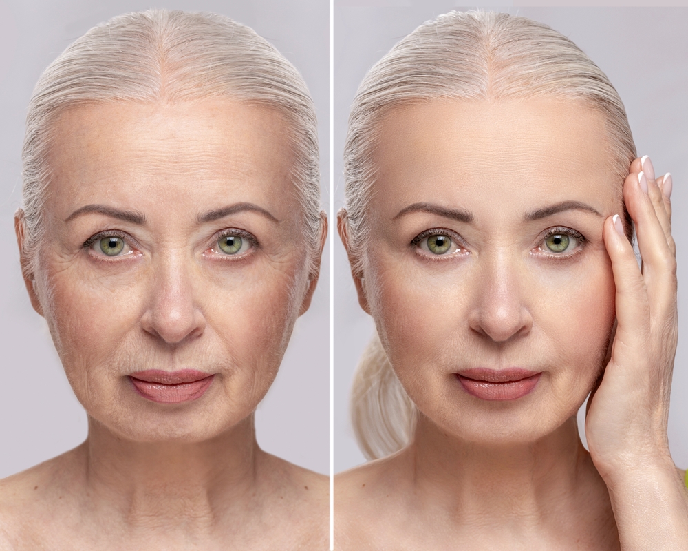 Facelift Surgery in Sri Ganganagar