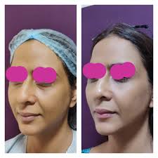 Fat Grafting in Sri Ganganagar