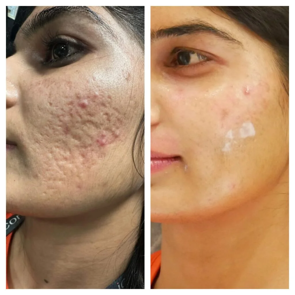 Fat Grafting in Sri Ganganagar