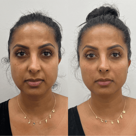 Full Face Makeover Treatment in Sri Ganganagar