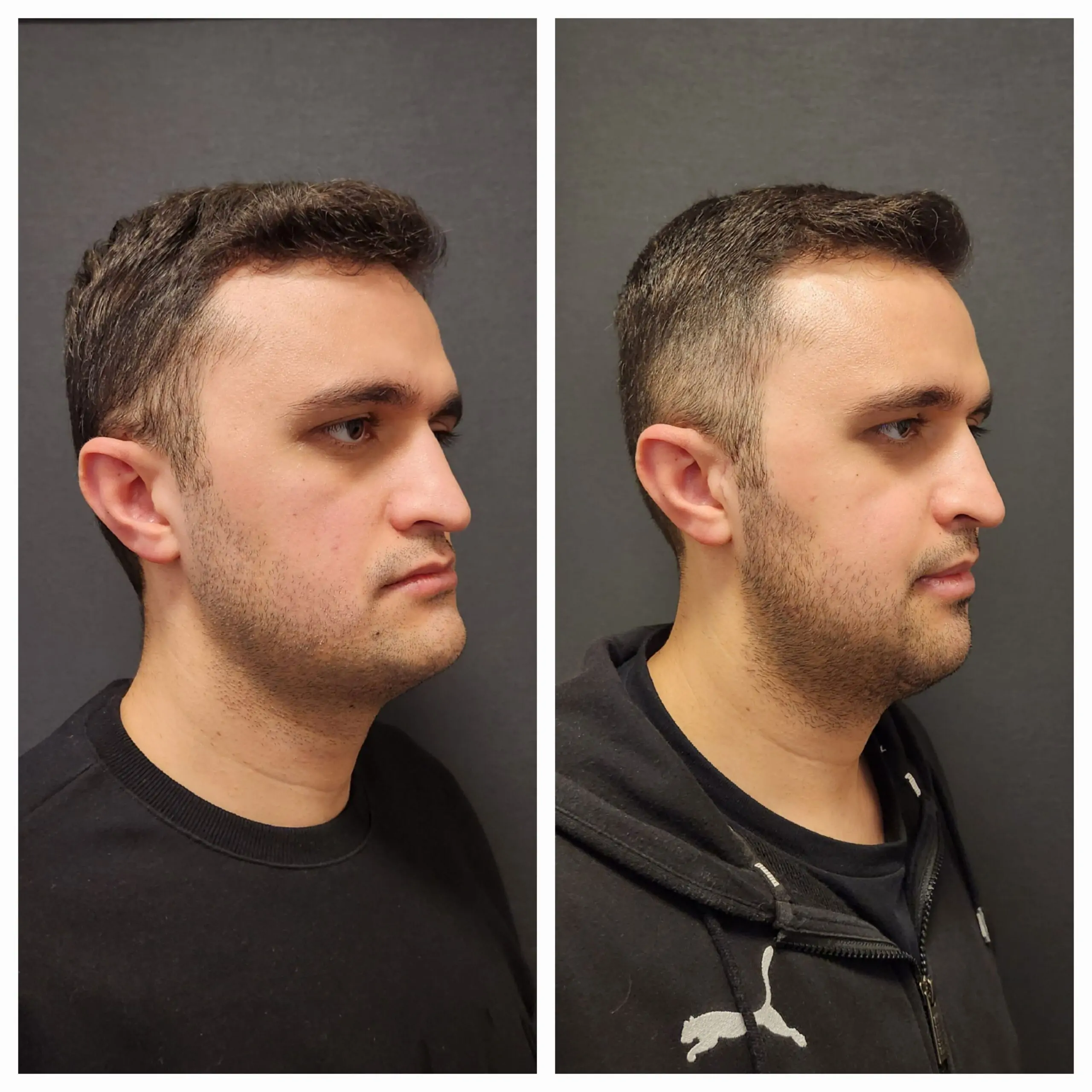Jaw Correction in Sri Ganganagar