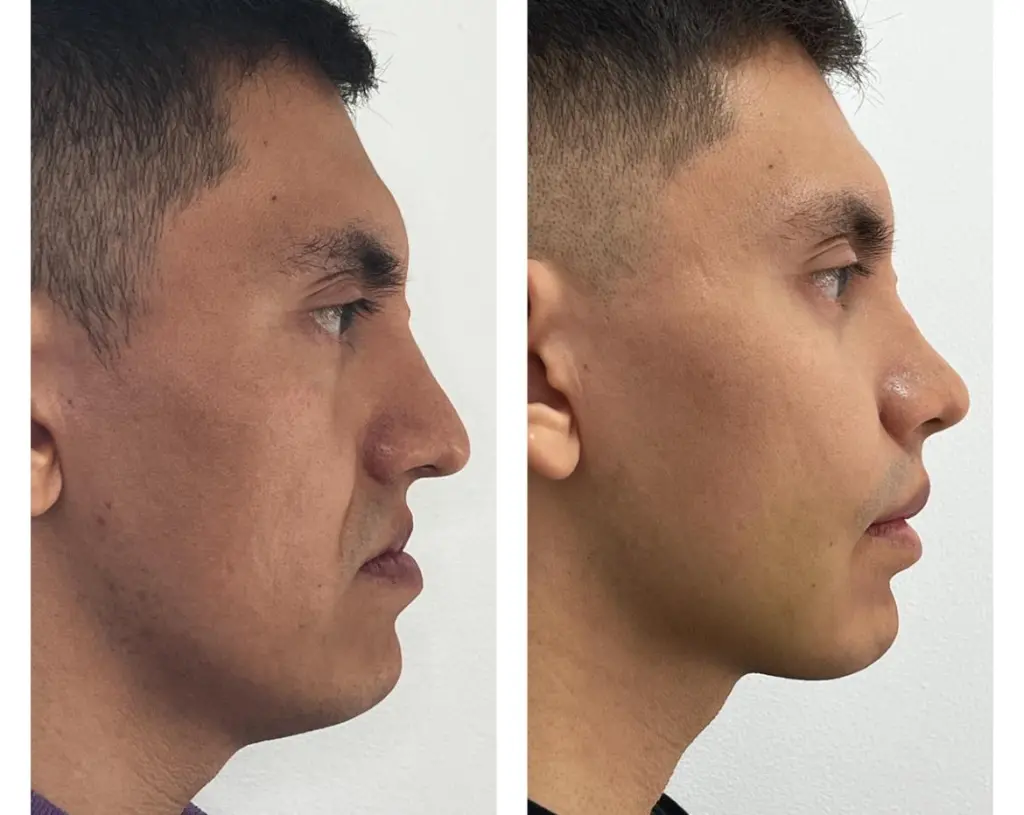 Jaw Correction in Sri Ganganagar