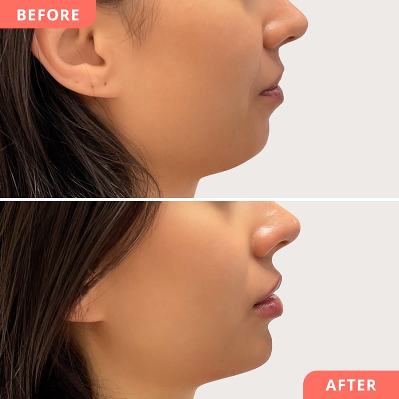 Jaw Line Correction in Bikaner