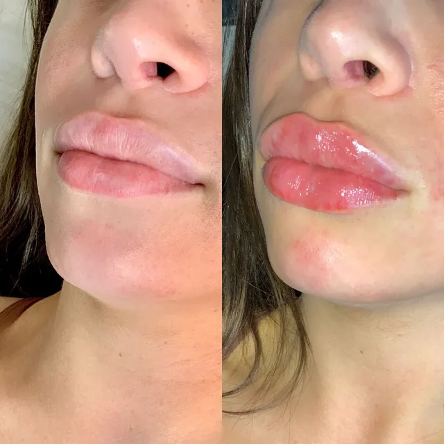 Lip Filler in Sri Ganganagar