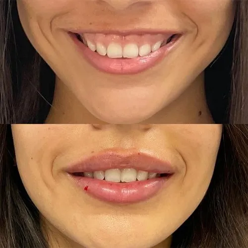 Lip Lift in Sri Ganganagar