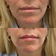 Lip Lift in Sri Ganganagar
