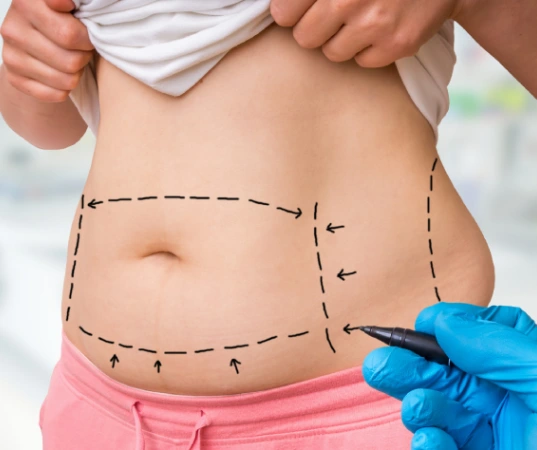 Liposuction in Sri Ganganagar