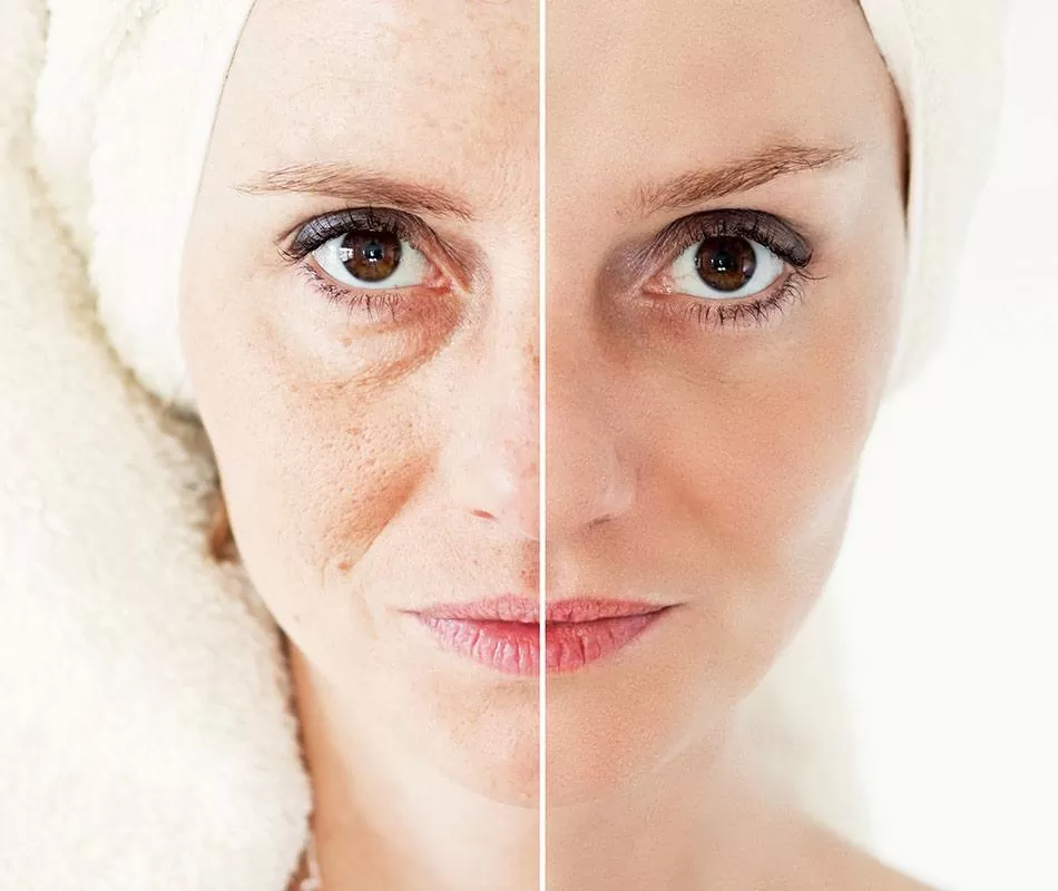 Non-Surgical Facial Treatment in Sri Ganganagar