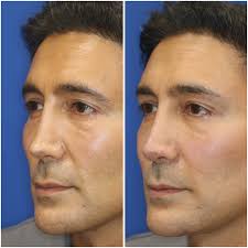 Non Surgical Permanent Face Makeover in Sri Ganganagar