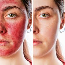 PRP Therapy in Sri Ganganagar