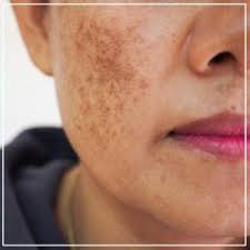 Pigmentation Corrections in Sri Ganganagar