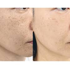 Pigmentation Corrections in Sri Ganganagar