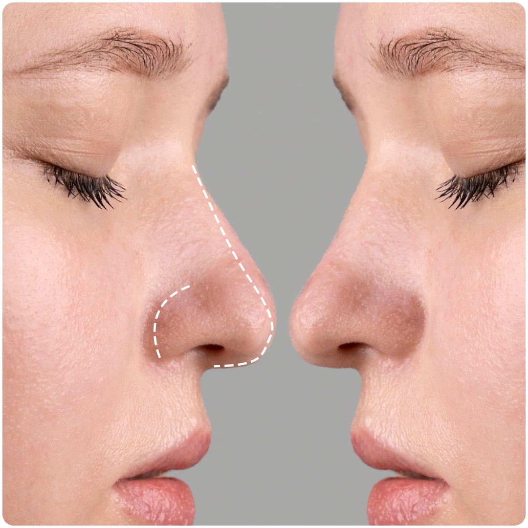 Rhinoplasty in Sri Ganganagar