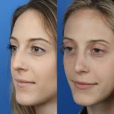 Rhinoplasty in Sri Ganganagar