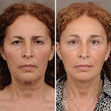 Surgical Facelift in Sri Ganganagar
