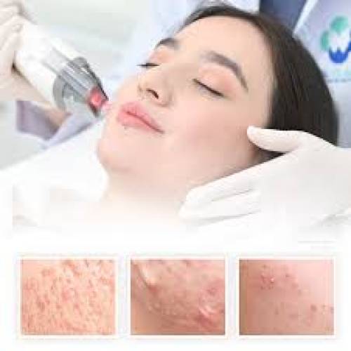 Acne Treatment in Sri Ganganagar