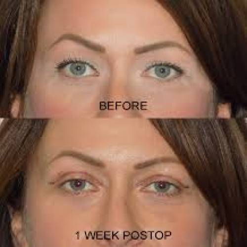 Blepharoplasty in Sri Ganganagar