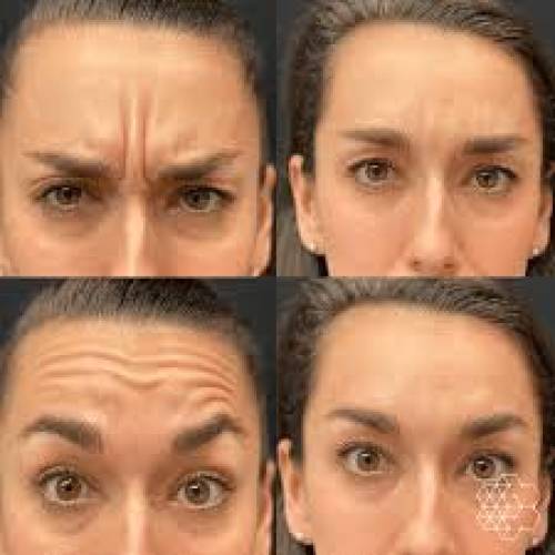 Botox in Sri Ganganagar