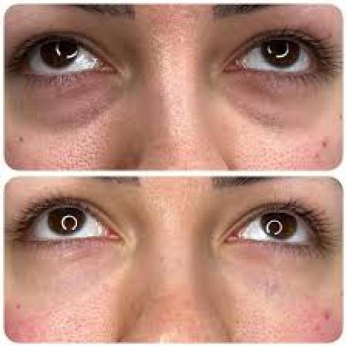Dark Circles Treatment in Sri Ganganagar