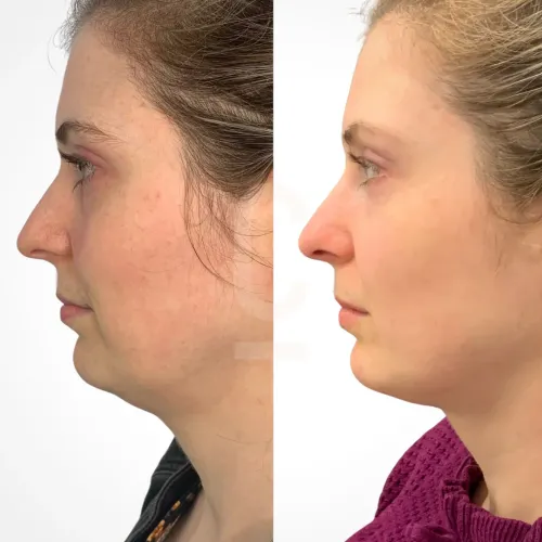 Double Chin Reduction in Sri Ganganagar