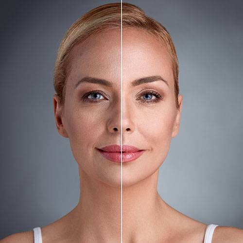 Face Fat Grafting in Sri Ganganagar