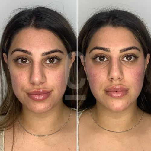 Face Slimming Treatment in Sri Ganganagar