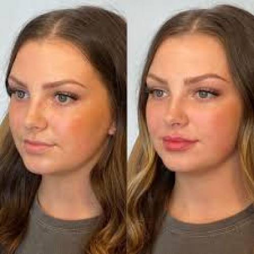 Fillers in Sri Ganganagar