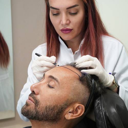 Hair Transplant in Sri Ganganagar