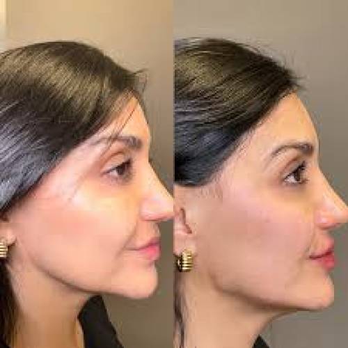 Jaw Line Correction in Bikaner