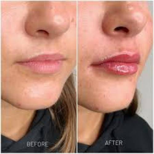Lip Filler in Sri Ganganagar