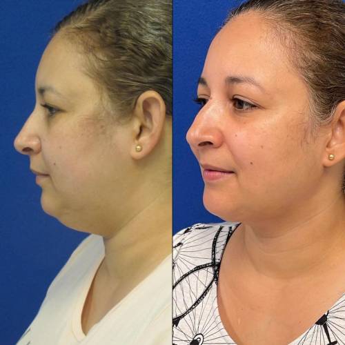 Liposuction in Sri Ganganagar