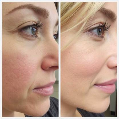 PRP Therapy Service in Sri Ganganagar