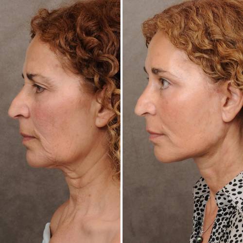 Surgical Facelift in Sri Ganganagar